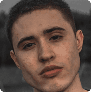 Acne (Mild to Severe)